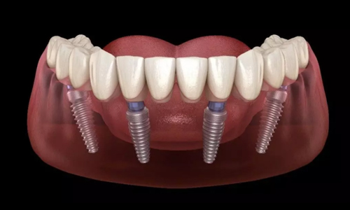 Step-by-Step All-on-4 Treatment Timeline