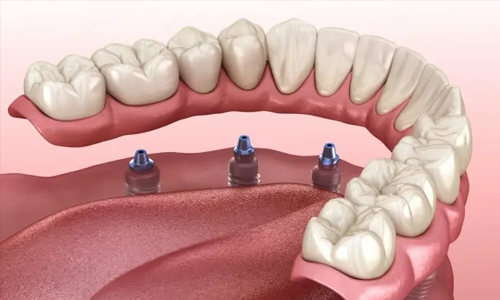 Good Candidates for Dental Implants
