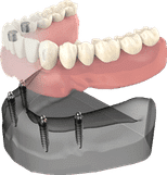 All-on-4 Implants