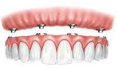 Digital illustration of dental implants with gum tissue and artificial tooth crowns positioned in mouth.
