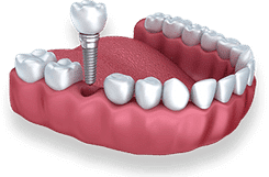 Dental implant model showing titanium screw fixture and crown placement in jawbone replica.